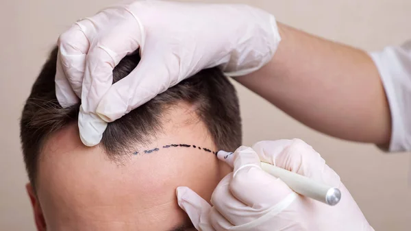 Advanced hair restoration procedures designed to restore natural hair growth and enhance hair density, including hair transplant, FUE (Follicular Unit Extraction), FUT (Follicular Unit Transplantation), and scalp micropigmentation. These treatments provide lasting results for both men and women, helping to restore a fuller, thicker head of hair and boost self-confidence. - Saç restorasyonu işlemleriyle doğal saç büyümesini yeniden sağlamak ve saç yoğunluğunu artırmak için saç ekimi, FUE, FUT ve saç mikropigmentasyonu gibi gelişmiş çözümler. Hem erkekler hem de kadınlar için kalıcı sonuçlar sunarak daha dolgun ve hacimli saçlar elde edilmesine yardımcı olur.