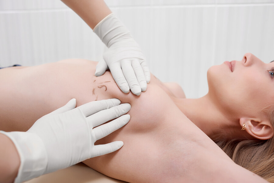 Breast Augmentation procedure performed by expert surgeons at Cmeday Beauty, showcasing enhanced breast size and shape for a more confident appearance.